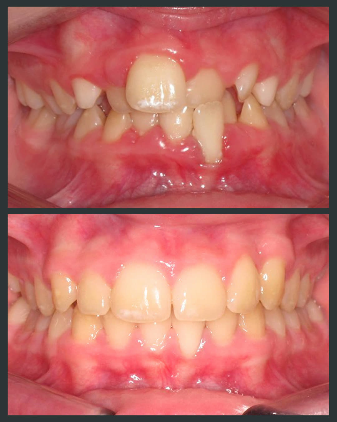 Before and after clear aligner treatment at Floss-it Dental Clinic