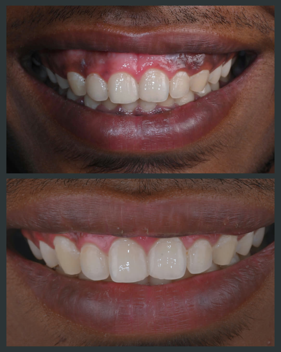 Before and after clear aligner treatment at Floss-it Dental Clinic